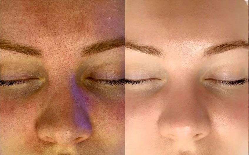 Resultados Antes y después del tratamiento Aquapure en Valencia