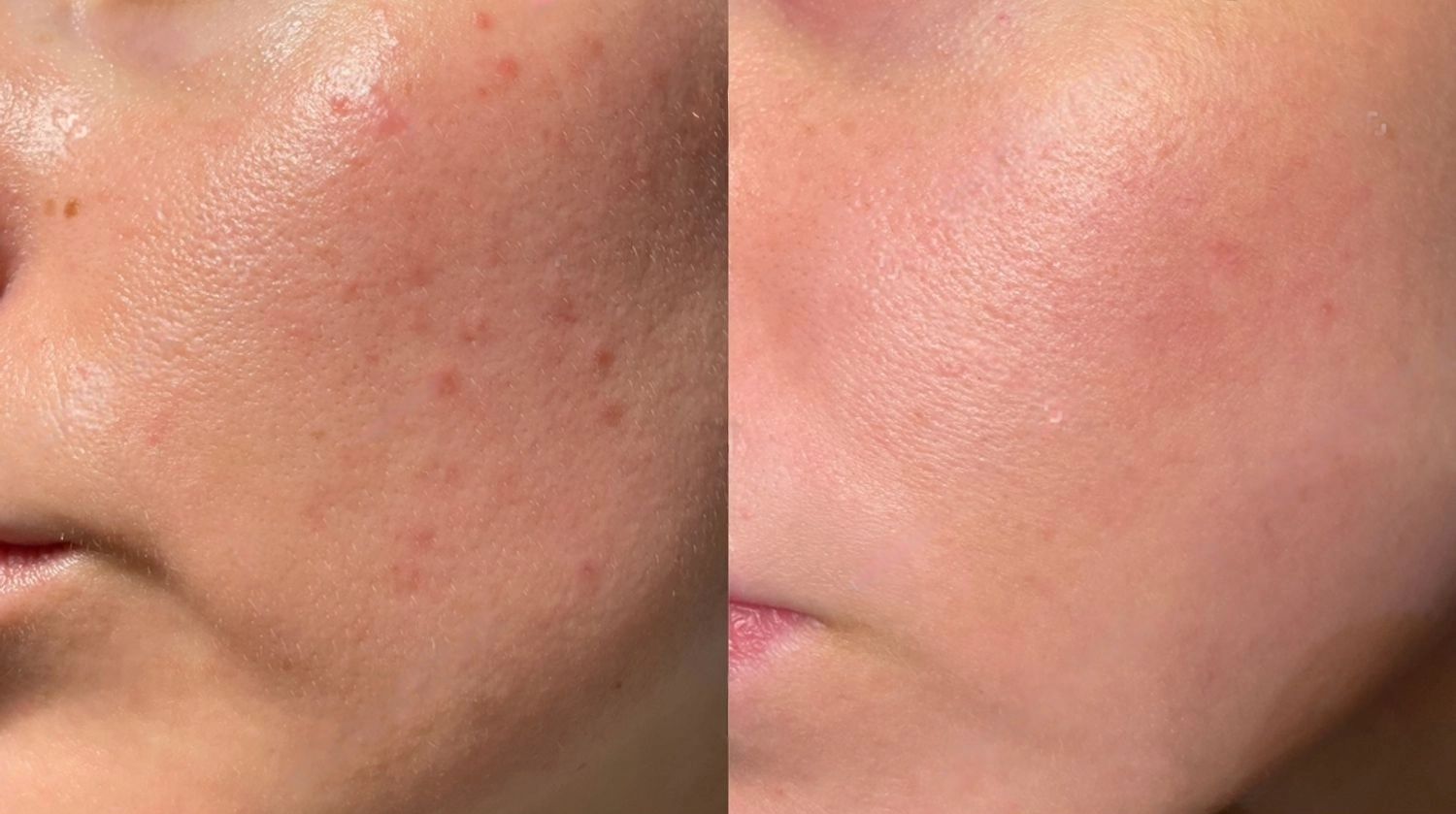 Resultados Exfoliación e hidratación