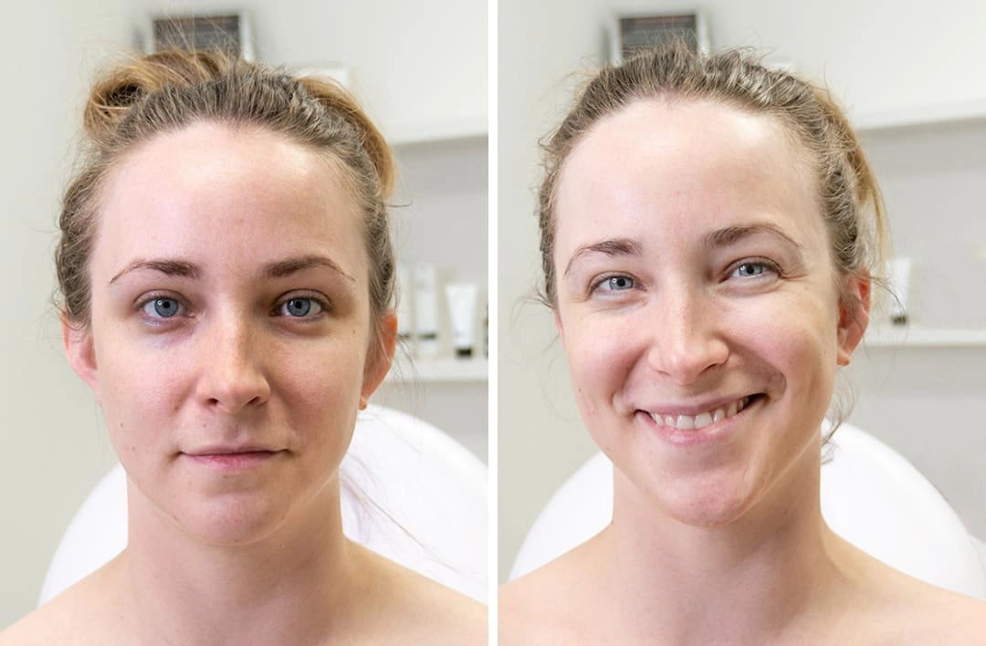 Resultados y Beneficios del tratamiento